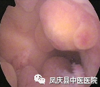 凤庆县中医医院妇产科成功开展宫腔镜手术(图3)