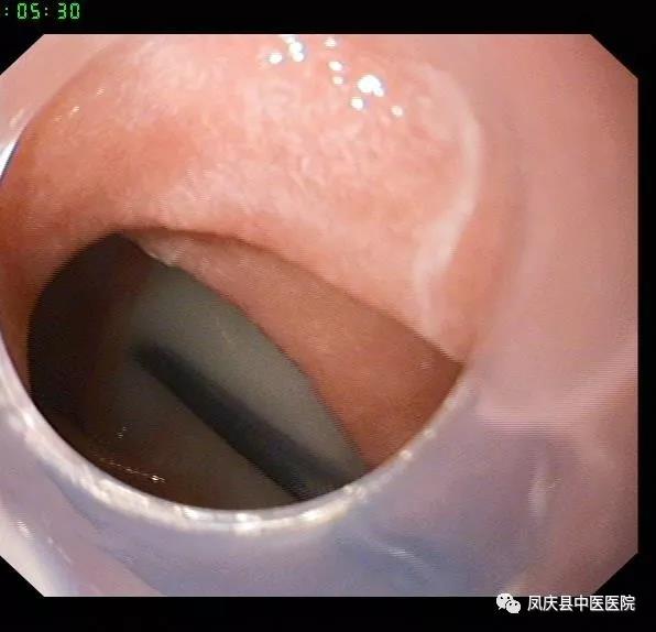 凤庆县中医医院脾胃病科经胃镜取出空肠内4cm钉子(图1)