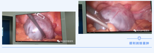凤庆县中医医院妇产科成功开展首例腹腔镜手术(图3)